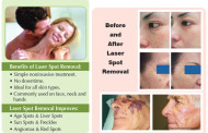 Don't hide them... Erase them with laser brown spot treatments and laser facial vein treatments - Enhanced Image Center