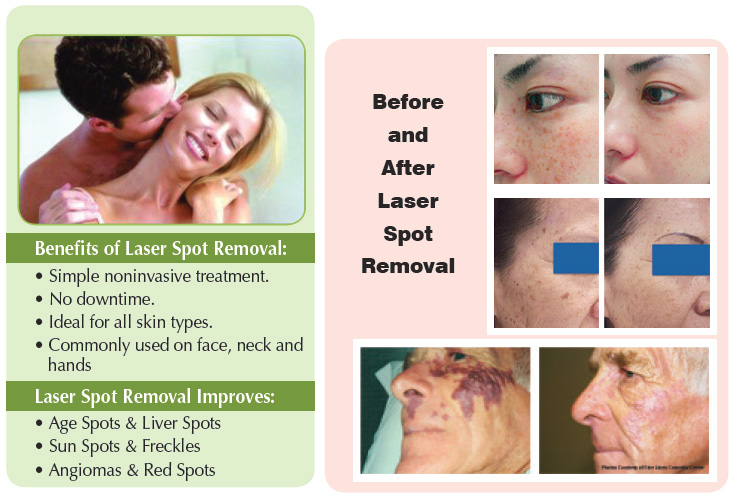 Don't hide them... Erase them with laser brown spot treatments and laser facial vein treatments - Enhanced Image Center